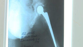 Операции эндопротезирования суставов отечественного производства проводят в Могилеве