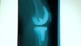 В Беларуси существует программа по бесплатной замене суставов